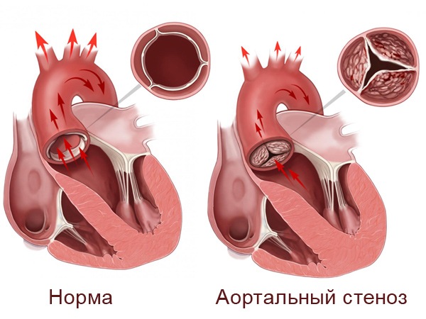 Аортальный стеноз клапана