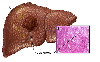 Гепатоцеллюлярная карцинома
