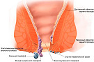 Геморрой