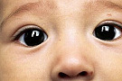 косоглазие у новорожденных