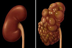 Поликистоз почек