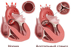 Аортальный стеноз клапана