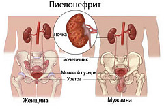 Пиелонефрит