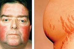 Болезнь Иценко-Кушинга