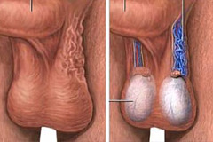 Варикоцеле