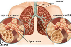 Хроническая обструктивная болезнь лёгких