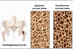 Остеопороз