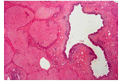 Болезнь Кароли (синдром Кароли)