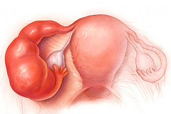 Сальпингоофорит (аднексит)