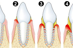 Пародонтит