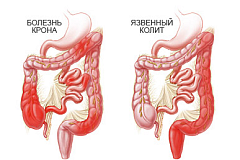Язвенный колит