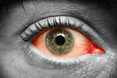 Конъюнктивит