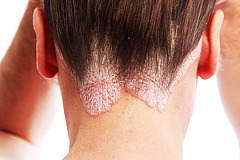 Псориаз